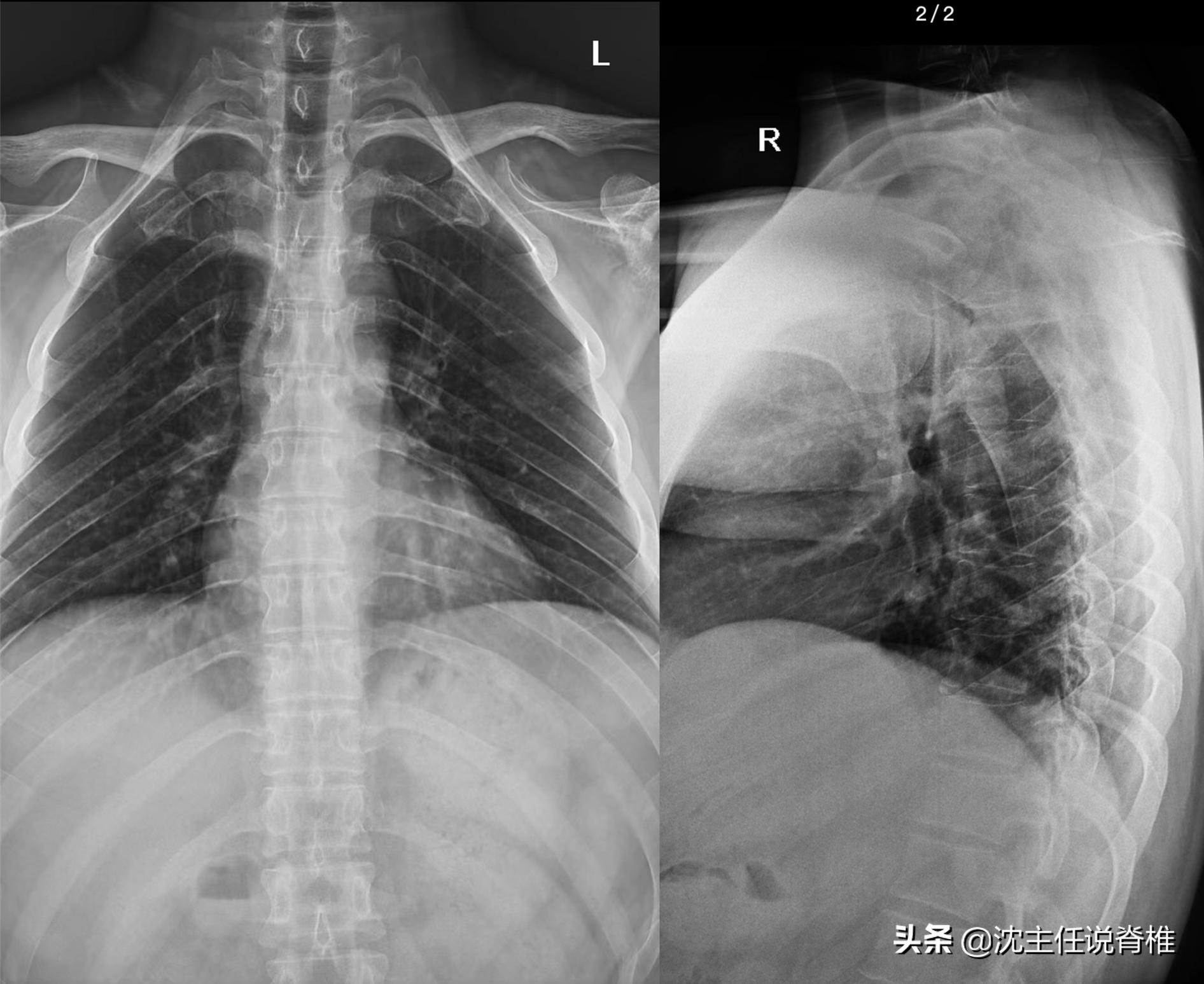左侧后背肩胛骨内侧缘隐痛,后背肩胛骨部位痛是有炎症吗
