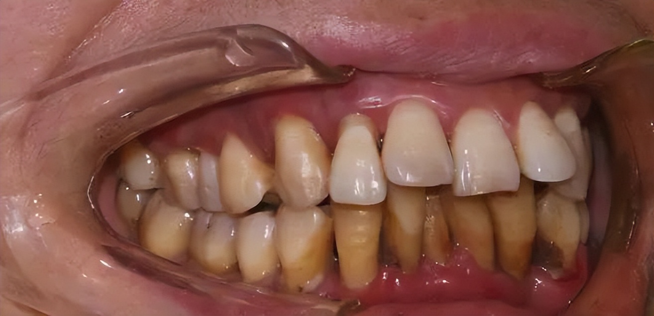 牙齿上面老是有软垢怎么办,牙齿黄黄的洗不干净