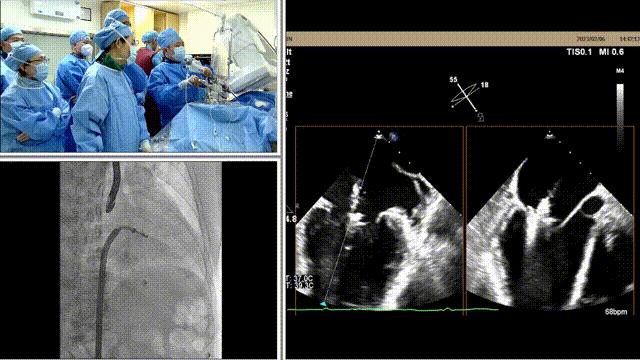 二尖瓣狭窄病例分享,二尖瓣病理生理及治疗方法