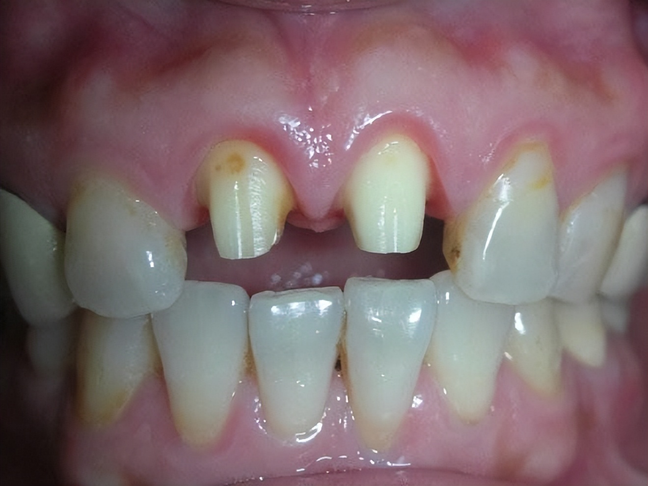 固定假牙一直发炎疼痛怎么办,为什么安了假牙后牙齿还是会痛