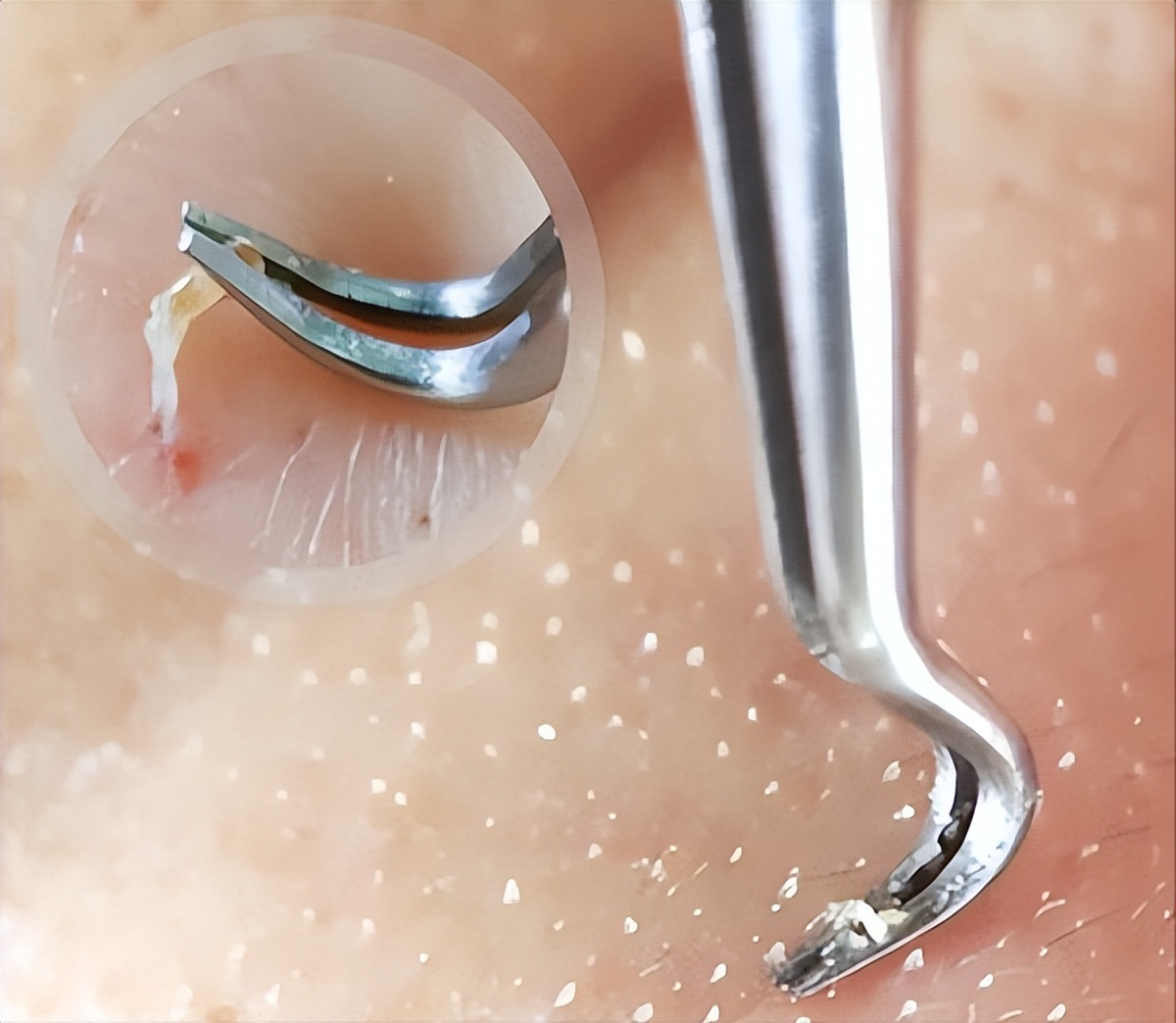 去鼻子上的黑头最好的方法,去鼻子上黑头的有效方法