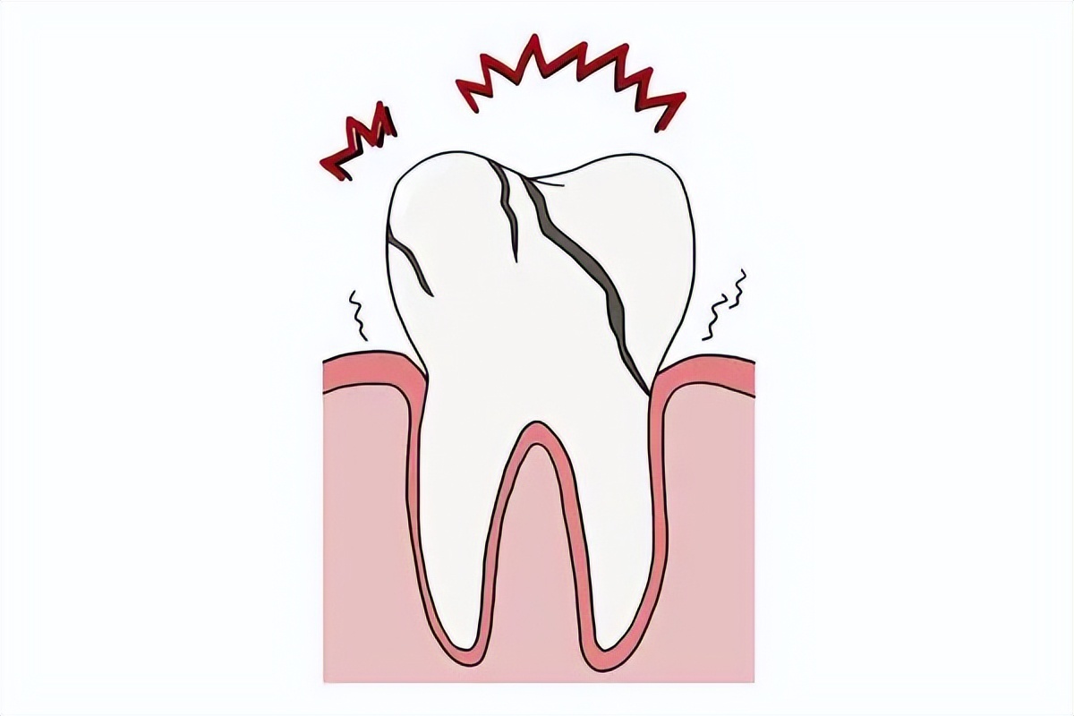 根管治疗牙齿劈裂还能保留吗,根管治疗后牙齿劈裂