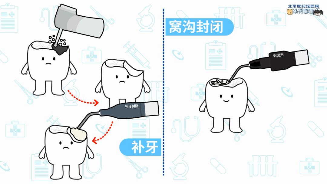 健康科普龋齿窝沟封闭,预防蛀牙科普视频