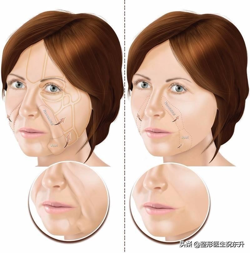 脸上有法令纹用什么办法把它消掉,法令纹和木偶纹的消除方法