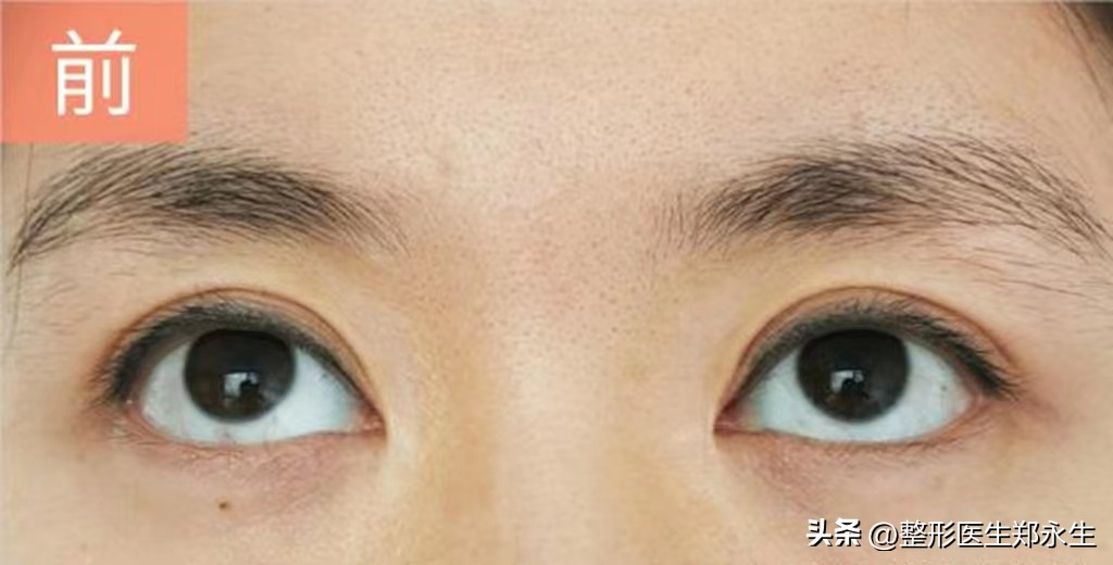 下眼睑凹陷眼睛后退,哪种情况属于眼睑外翻