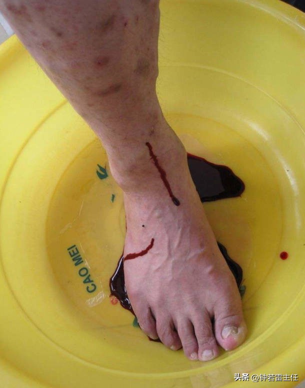 老烂腿早期治得好吗,四处求医的经历