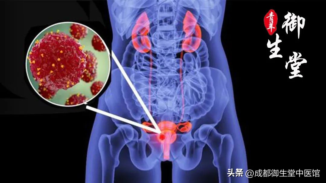 膀胱癌能中医治疗吗,膀胱癌中医怎么治疗更有效