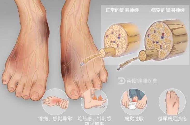 甲钴胺是什么药品治疗什么的,甲钴胺治疗神经每天吃几片最好