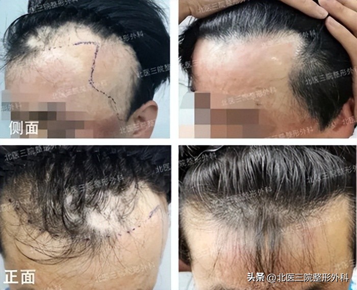 三种方法治疗头皮疤痕,头皮疤痕用什么淡化