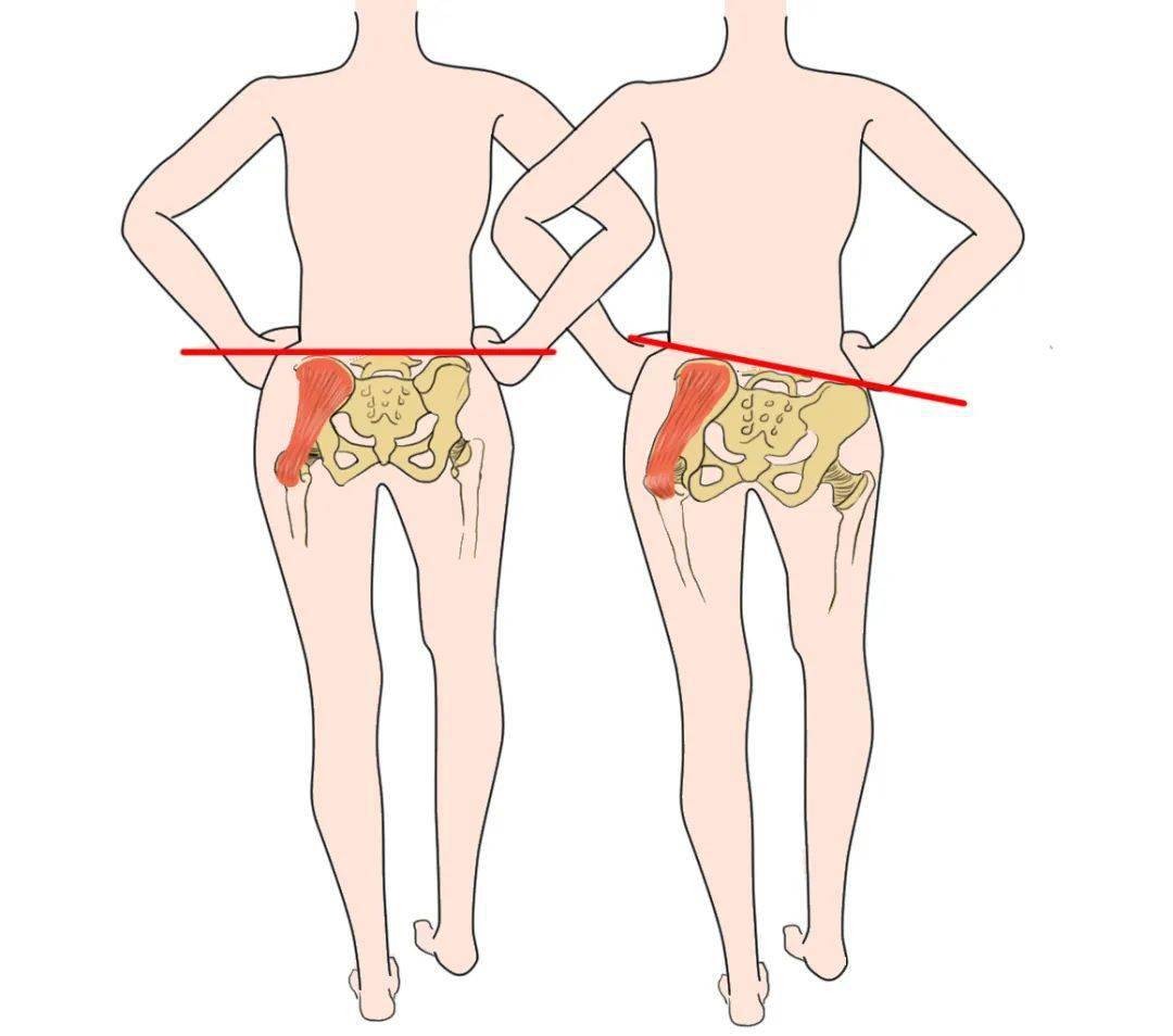 走路像鸭子是哪块肌肉的问题,走路像鸭子一样的是什么原因