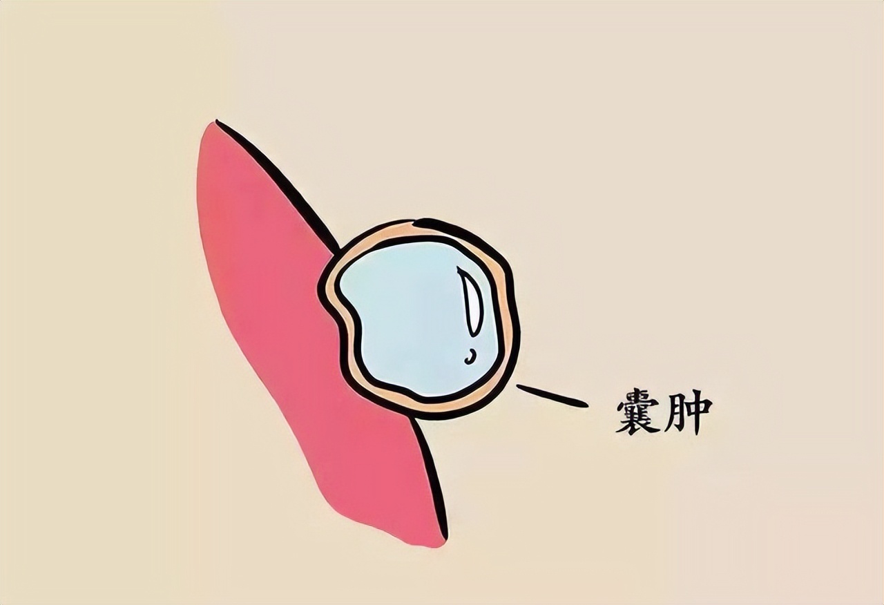 医生说有囊肿但不要紧,医生说有囊肿是什么意思