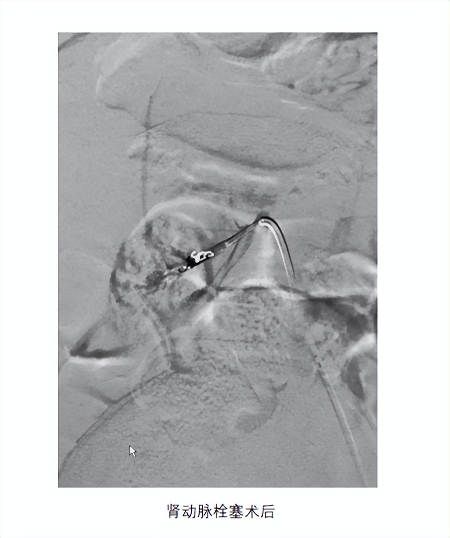 异位肾最佳治疗方法,异位肾要做手术吗