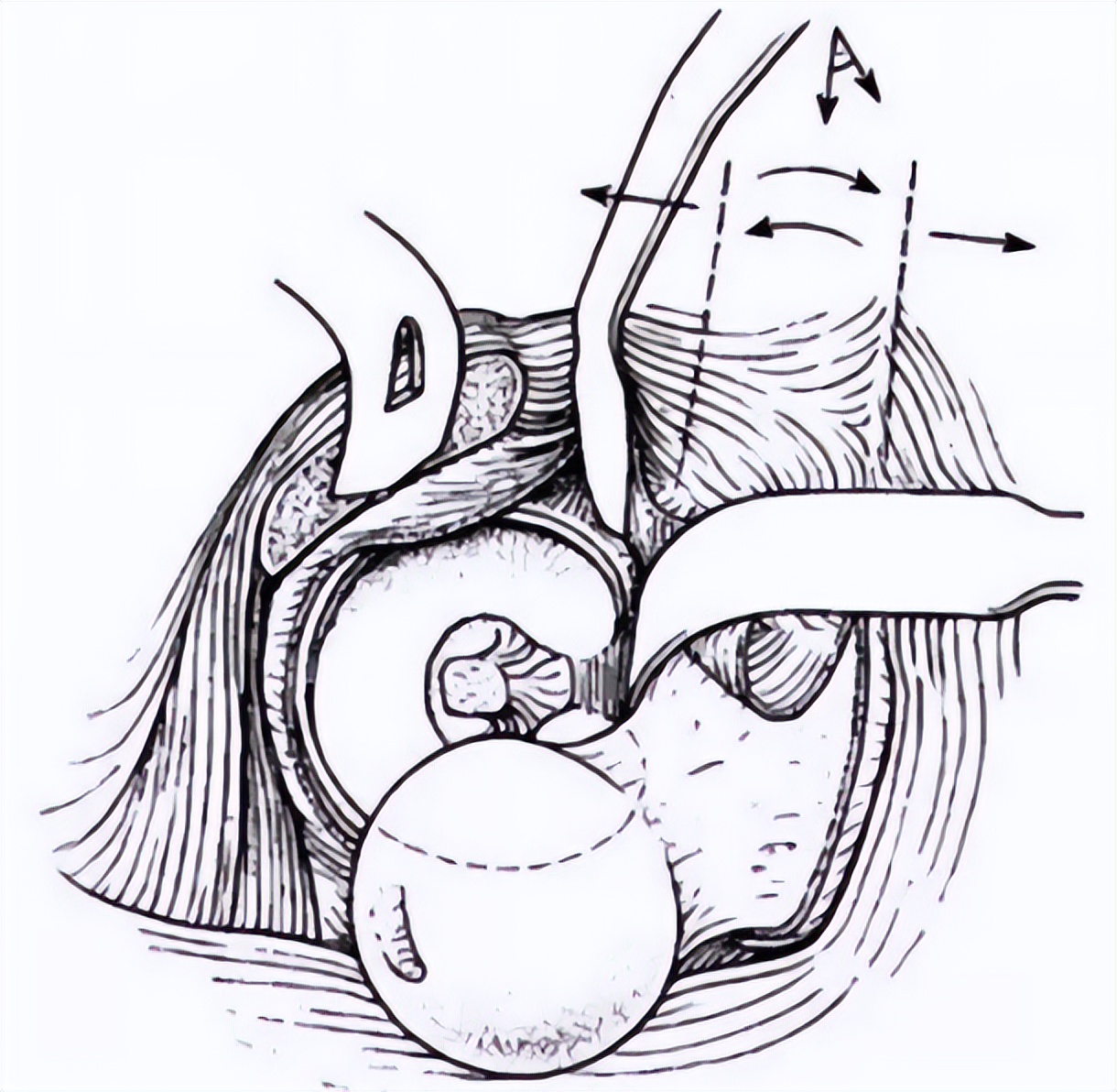 老人股骨头骨折手术,股骨头骨折最佳手术方法