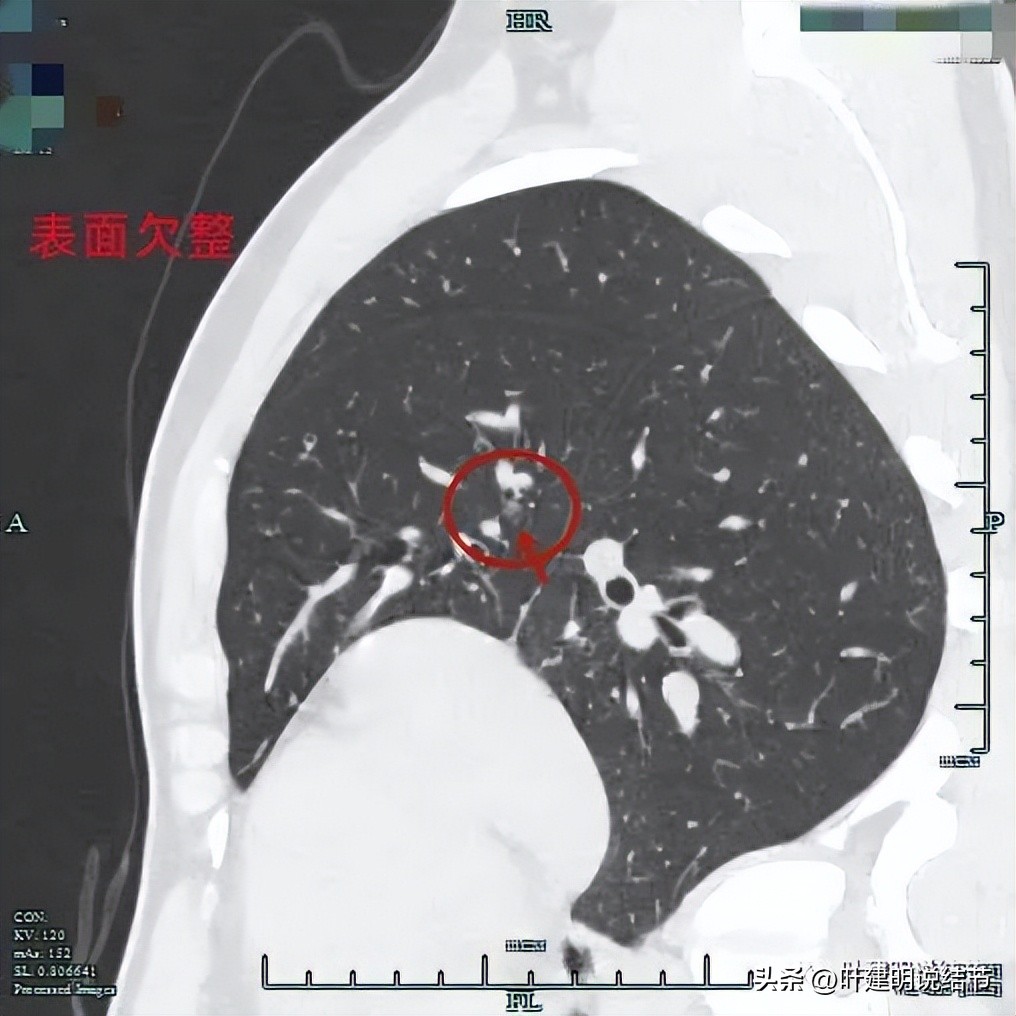 中叶多发微小结节,男性30岁右侧甲状腺单发结节