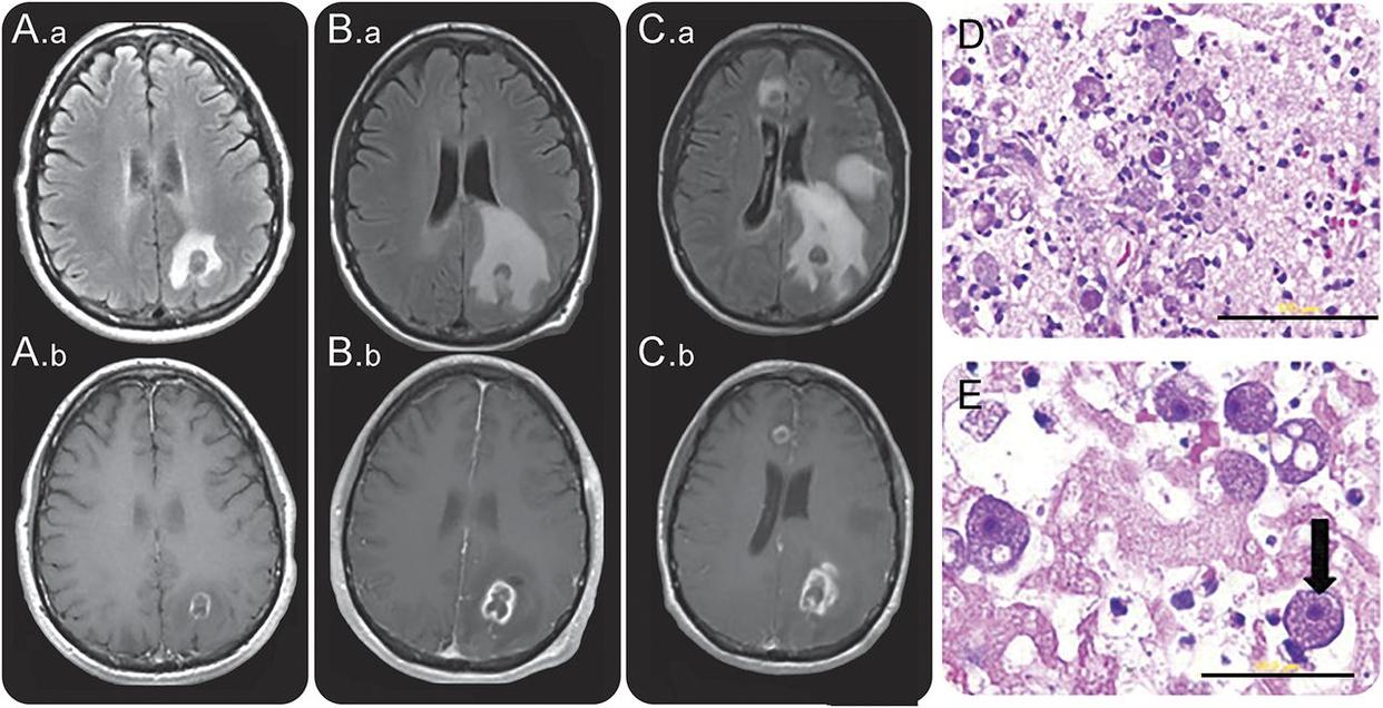 6点男童游泳后感染“食脑虫”,6岁男童一游泳后感染“食脑虫”