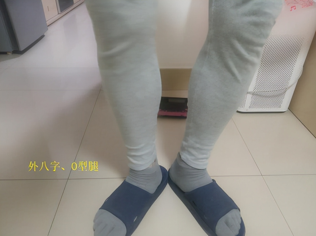 xo型腿是什么样的,xo型腿的矫正方法