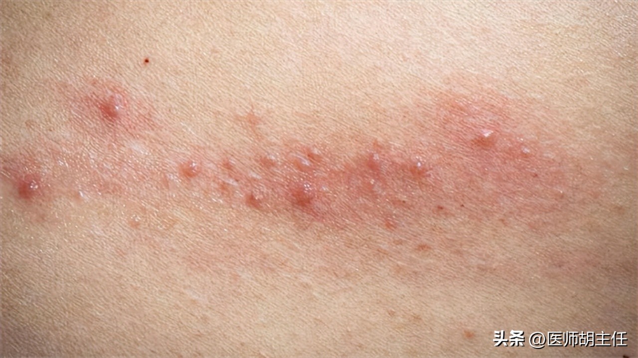 带状疱疹令人疼痛难忍该如何预防,哪些是带状疱疹患者要纠正的误区