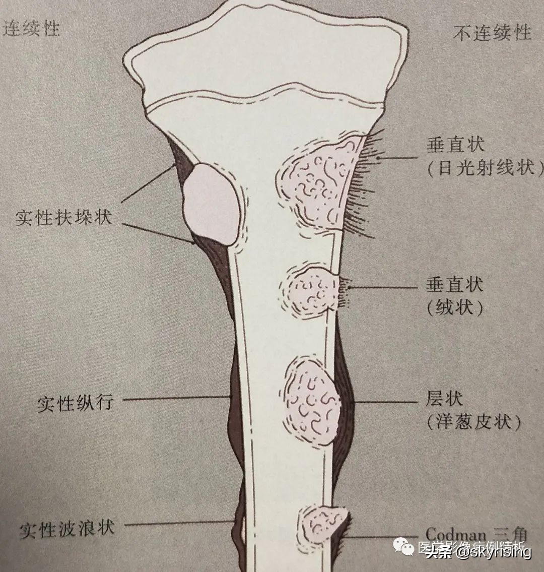 脊索瘤造成骨质破坏严重吗,多发椎体骨质破坏考虑转移瘤