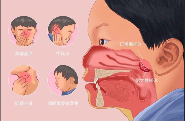 扁桃体腺样体肥大：手术治标中医治本，讲4个中医常用方法，收好