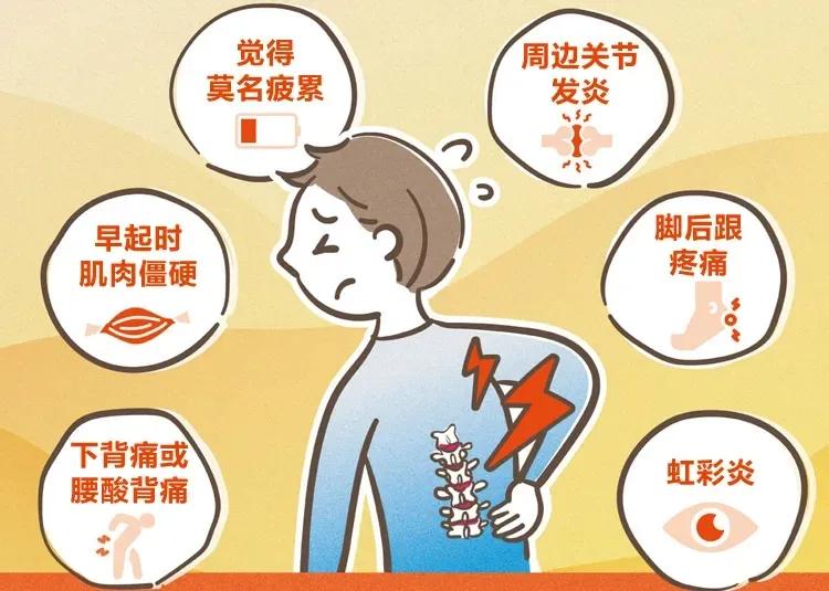 济南强直性脊柱炎脚后跟疼,强直性脊柱炎引起脚跟肿痛