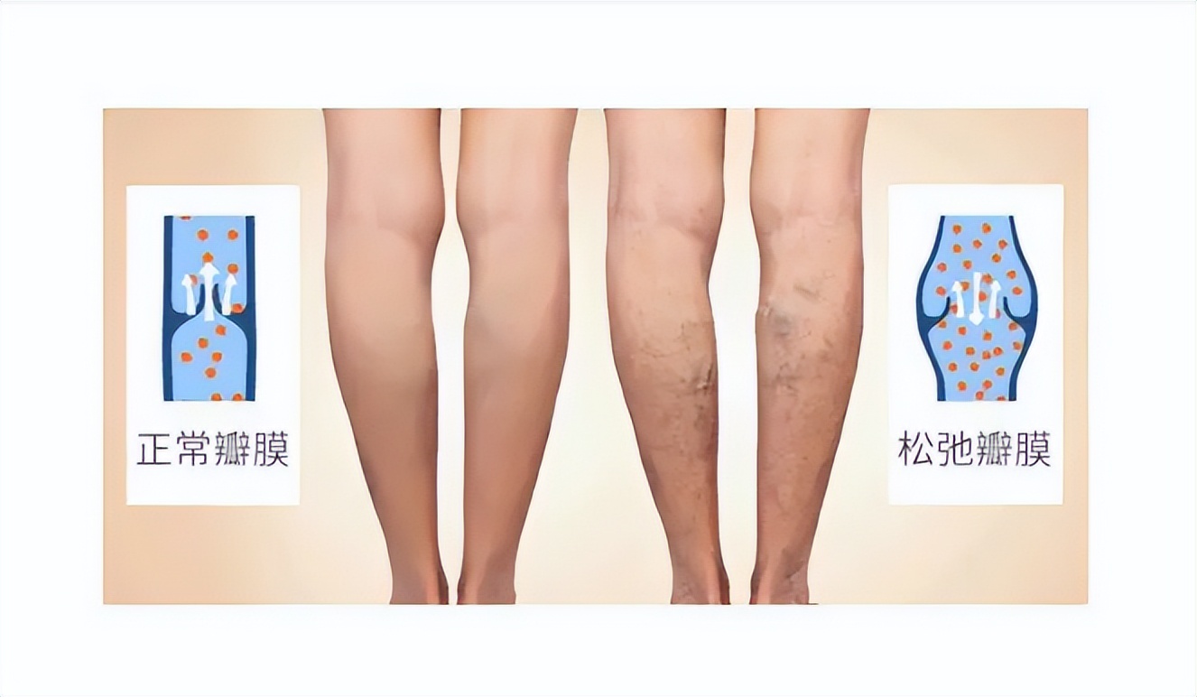 北京医院血管外科李鹏:下肢静脉曲张,如何治疗?