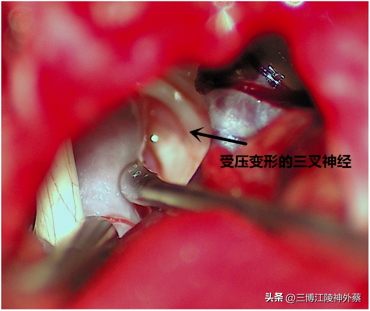 「案例」同侧同时出现面肌痉挛和三叉神经痛,如何治疗?