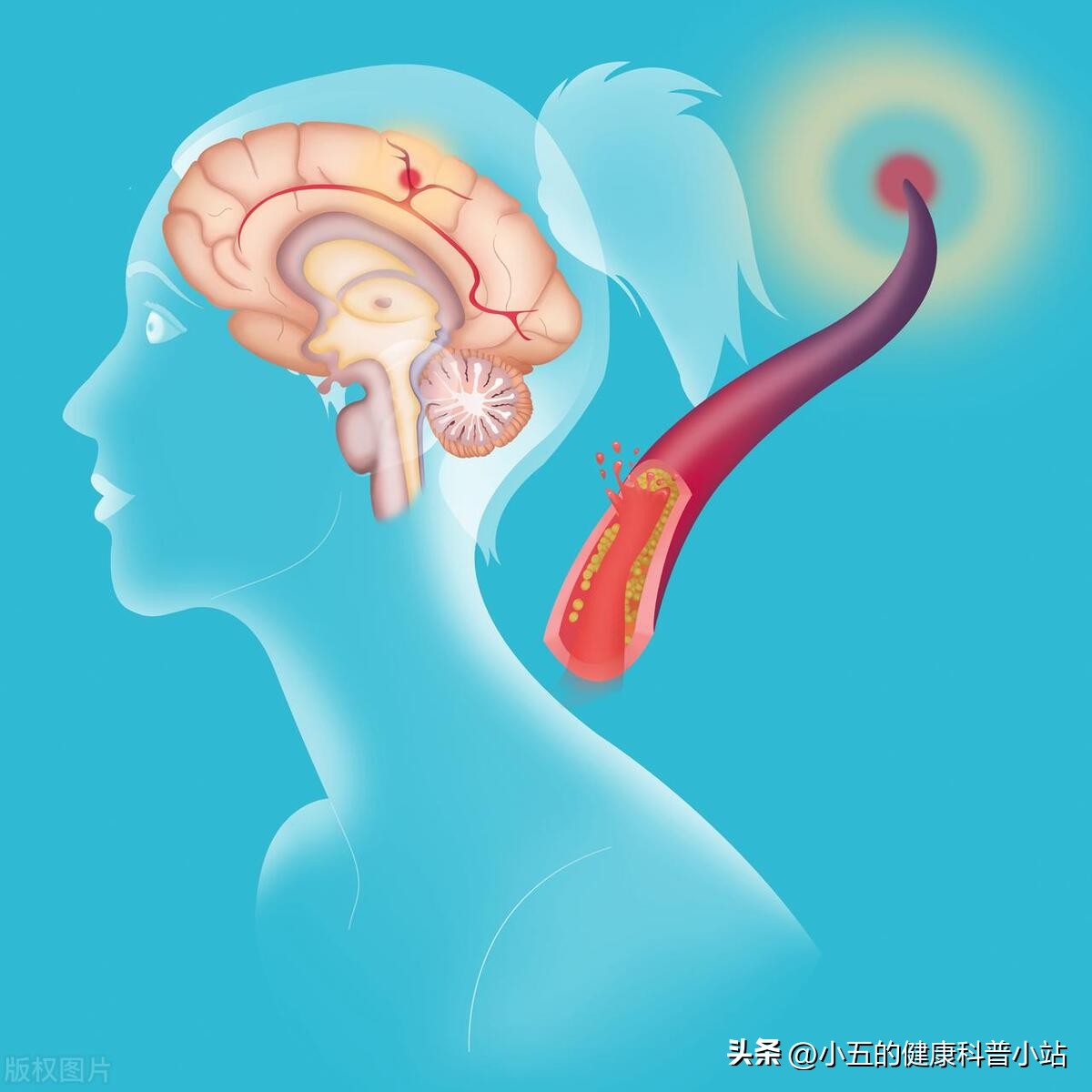 改善脑供血预防老年痴呆的方法,脑供血不足怎样防治才不会成痴呆