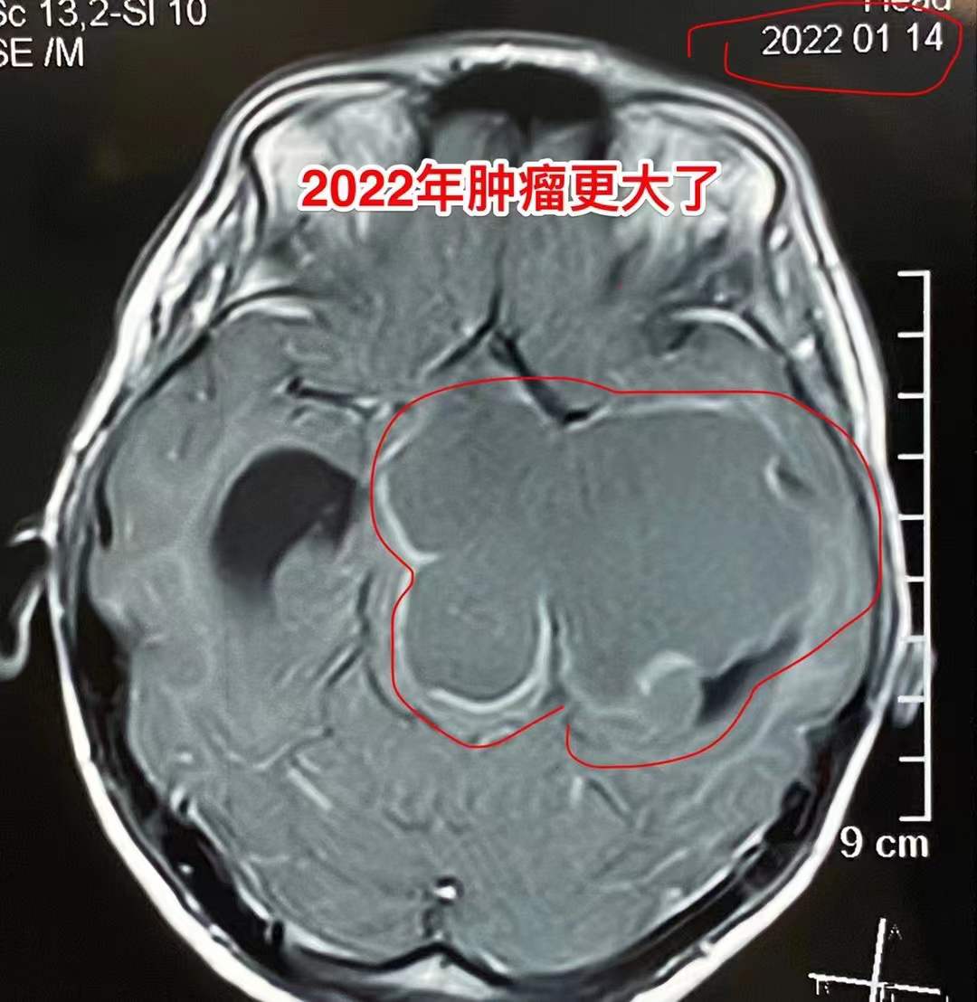 误区！吃中药能控制颅咽管瘤！颅咽管瘤最有效的治疗是手术