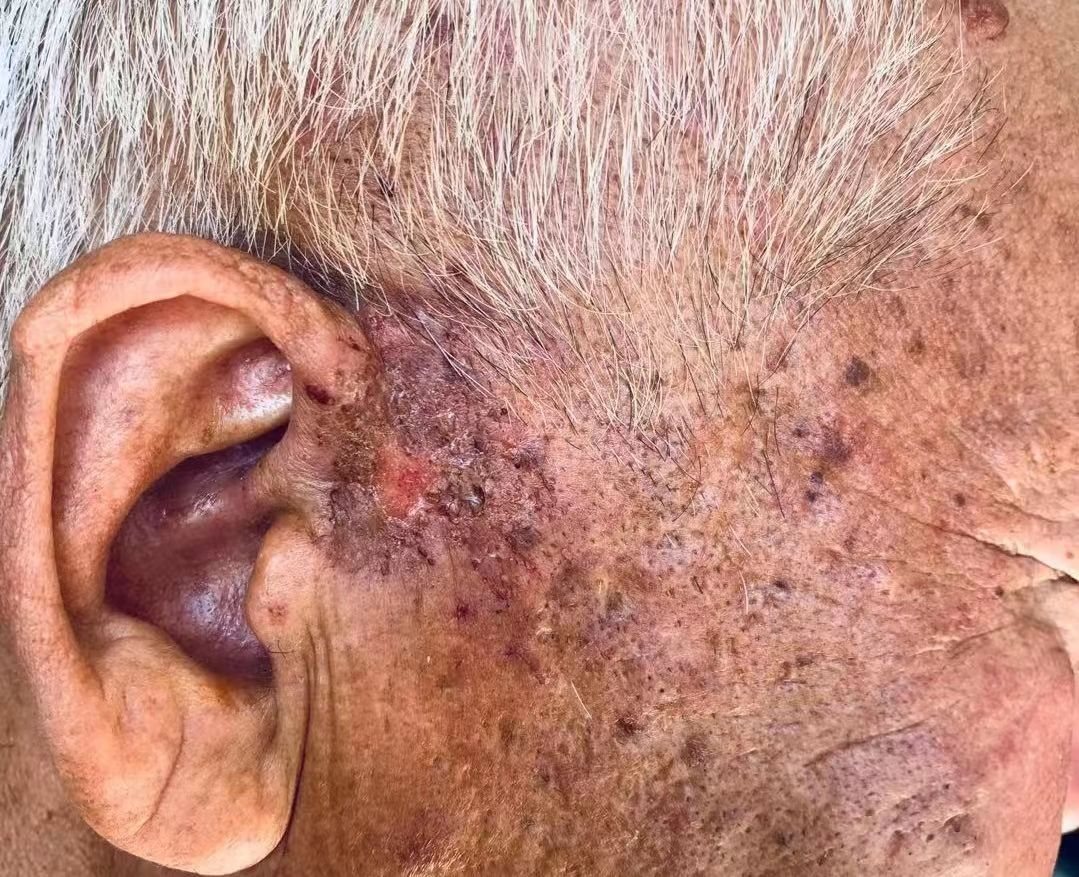 与荨麻疹抗争的经历,与痘痘抗争的每一天