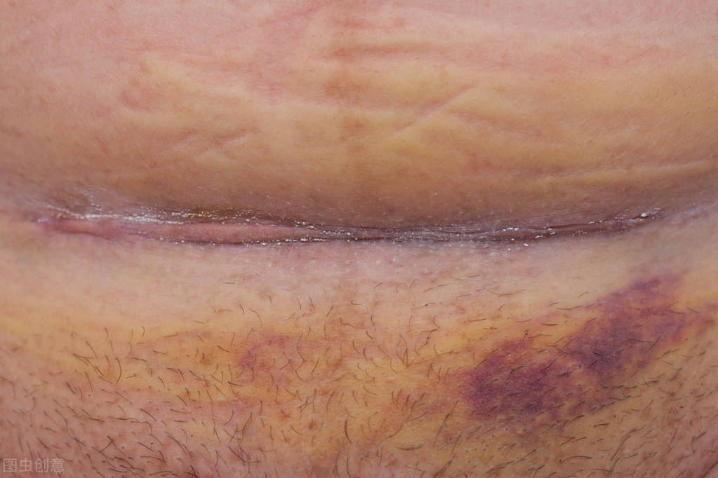 去除剖宫产疤痕增生最有效的方法,剖宫产疤痕憩室怎么去除