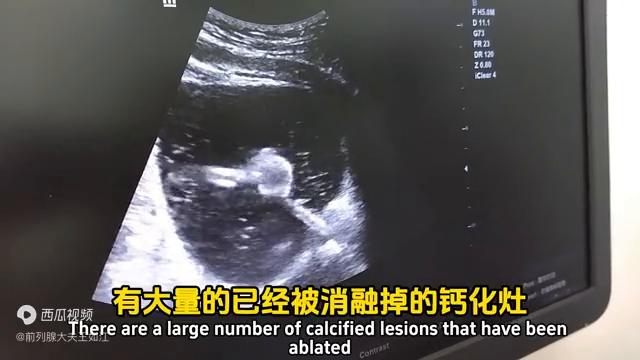 孔医生治疗前列腺炎,经尿道前列腺消融治疗步骤