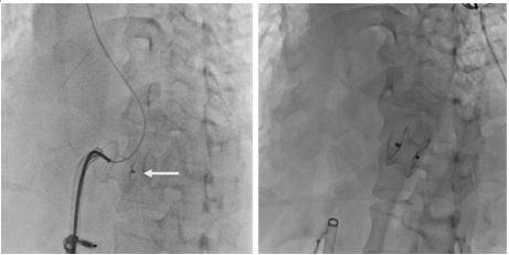 惊险！介入封堵，挽救“破裂”的心