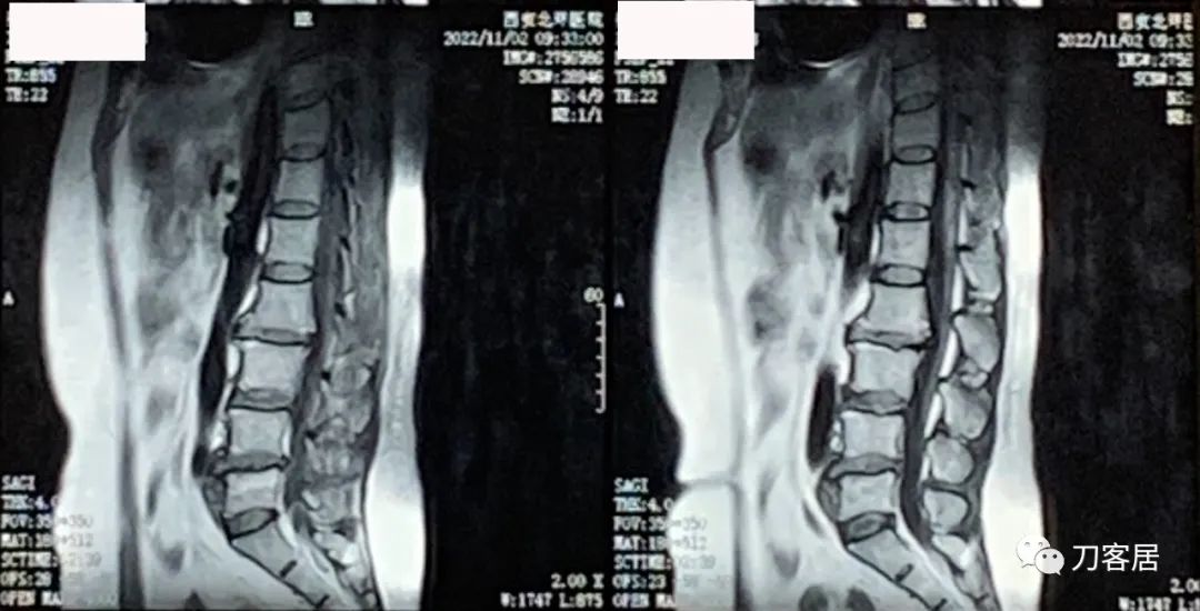 感染新冠左侧腰腹抽痛,腿酸疼是新型冠状病毒怎么治疗