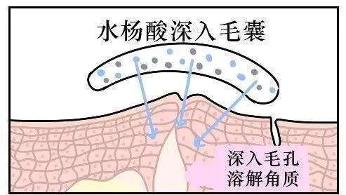 身体刷酸真实测评,美容院刷酸靠谱吗