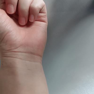 狐臭用什么喷剂效果最好不过敏,狐臭过敏缓解方法图片大全