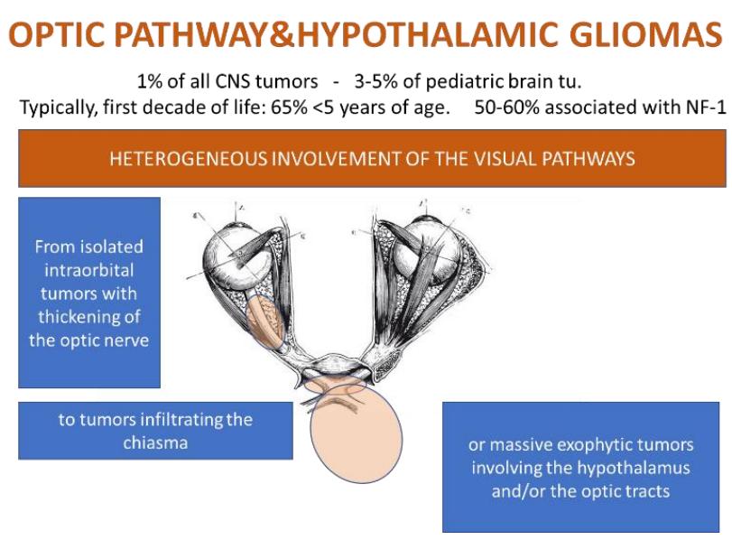 全球脑胶质瘤名医,世界神经外科专家