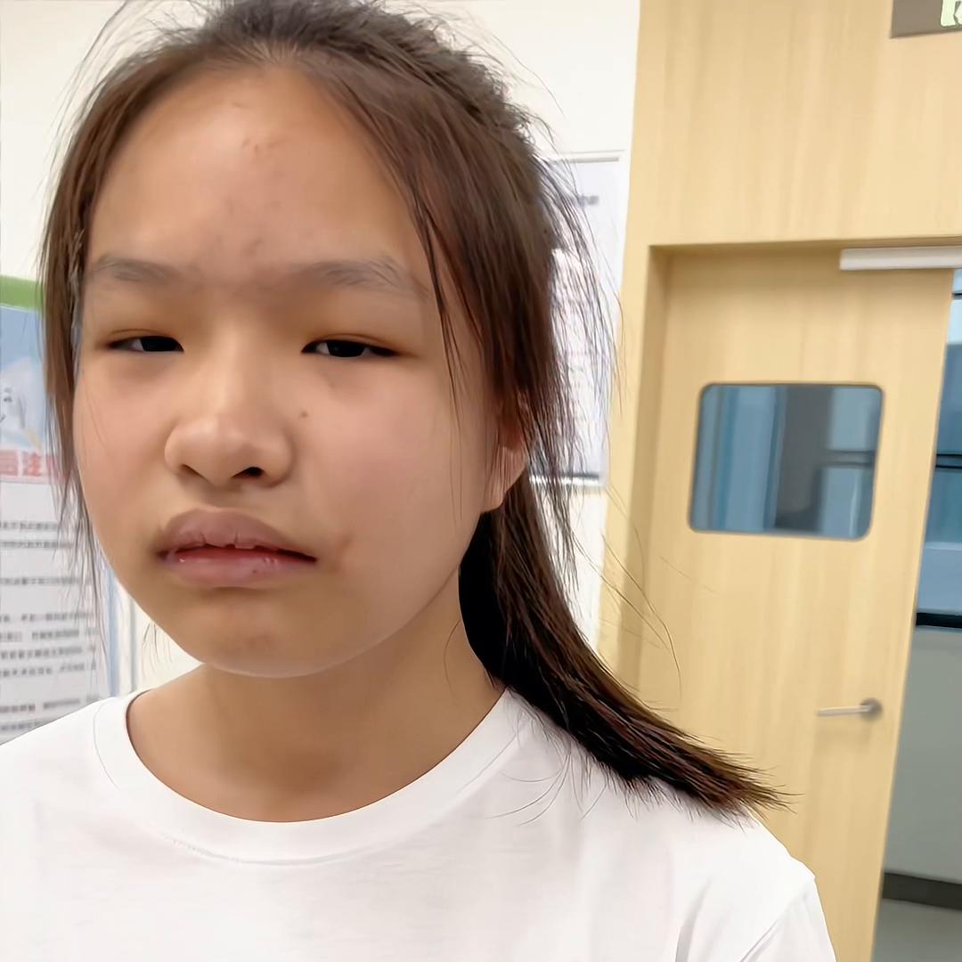 矫正牙齿拔牙开颌的全部过程,牙齿矫正拔牙后牙洞恢复过程图