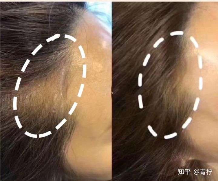 防脱洗发水好文,防脱洗发水用一次有没有事