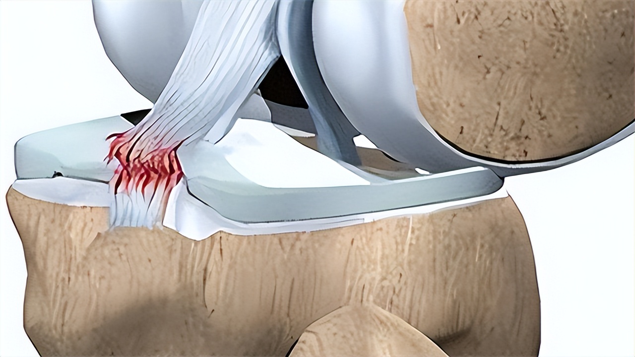 膝盖发软怎么回事是缺钙吗,走路膝盖突然软一下是缺什么