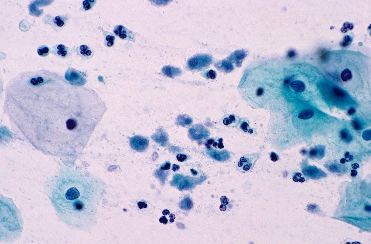 五种性传播的病,能通过性传播的疾病有哪些