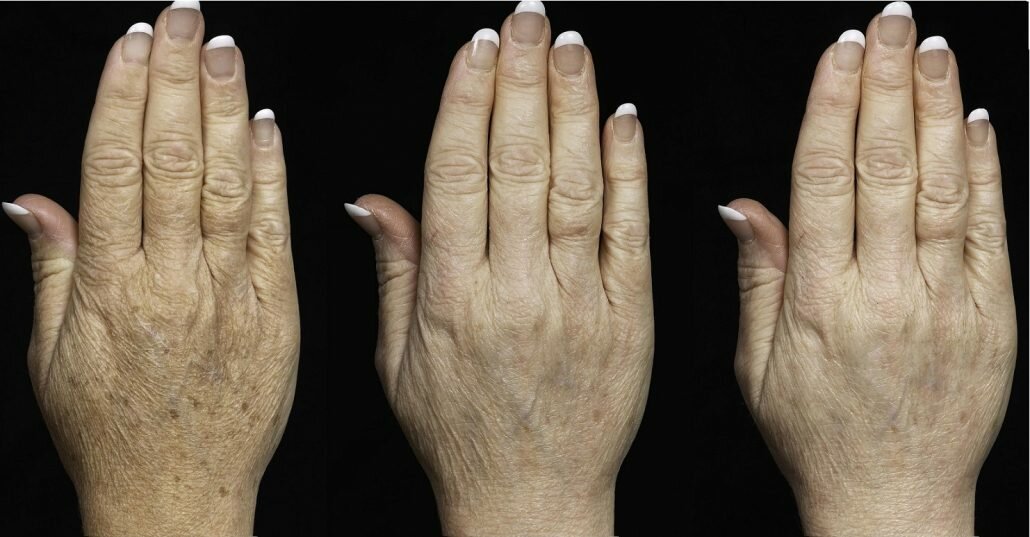 双手的青春面具:消除衰老迹象的配方