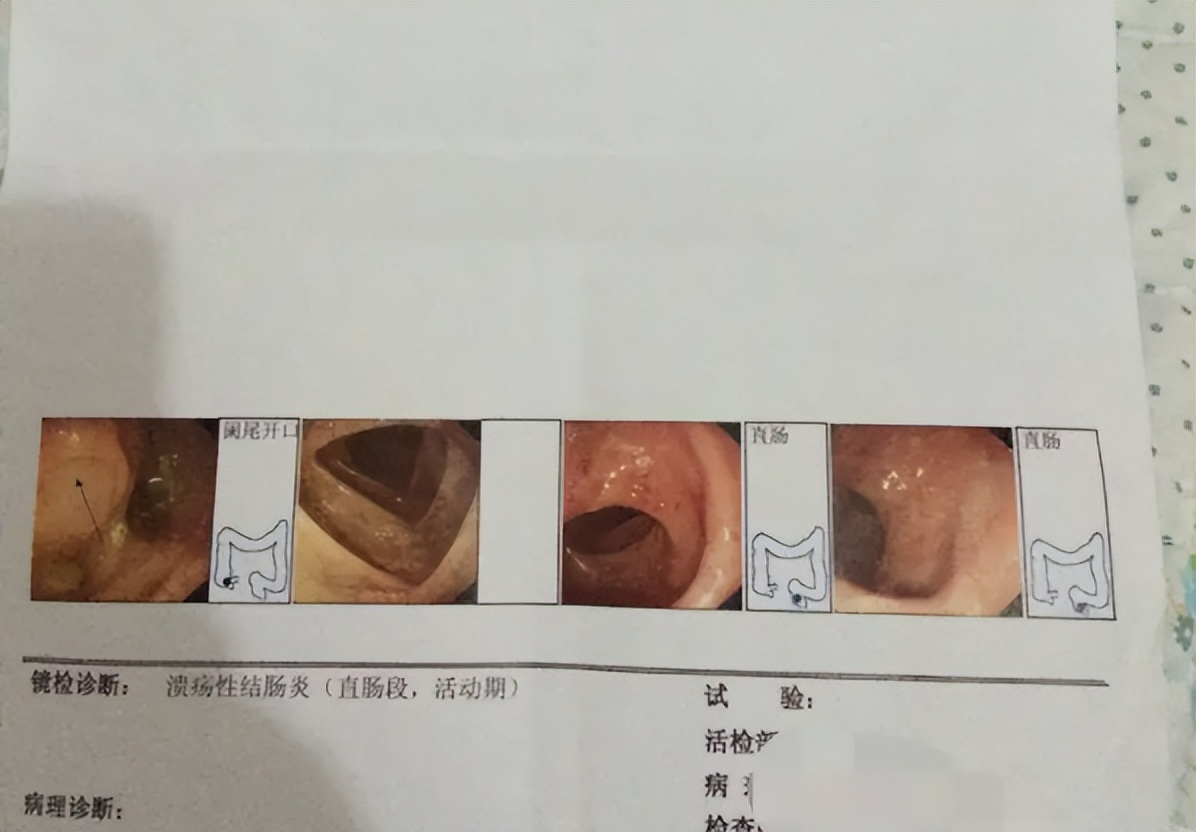 溃疡性结肠炎服用美沙拉嗪十年,溃疡结肠炎吃美沙拉嗪能治好吗