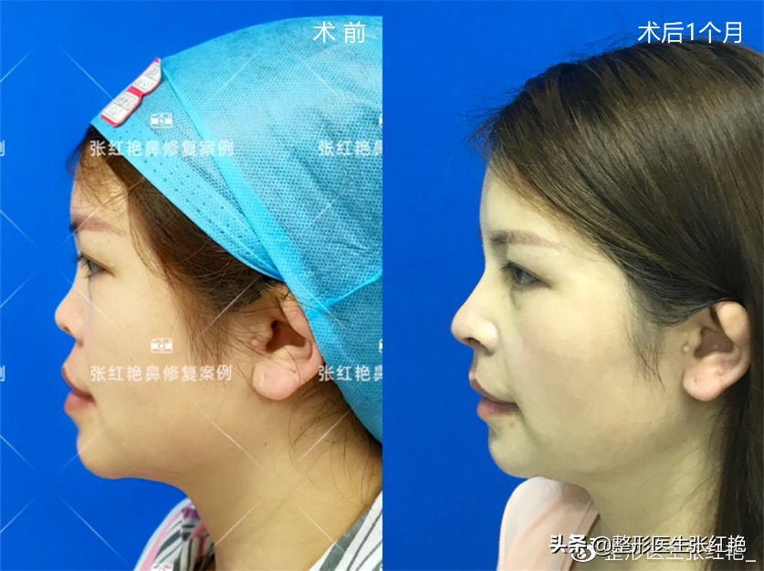 塌鼻头大鼻头怎么修容,塌鼻子和大鼻头如何变高挺