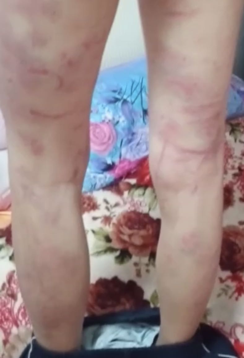 重庆彭水12岁孩子被打,13岁男孩遭继母殴打满身伤痕累累