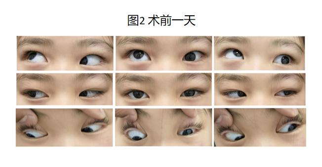 小儿眼睛被撞,小孩眼睛被同学撞肿了怎么办