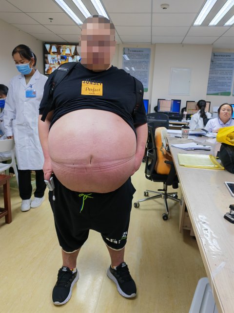 治疗打鼾减肥运动,打鼾治好反而瘦了