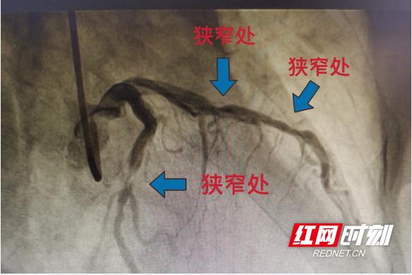 临澧县中医医院心血管内科为八旬老太成功实施冠脉支架植入术