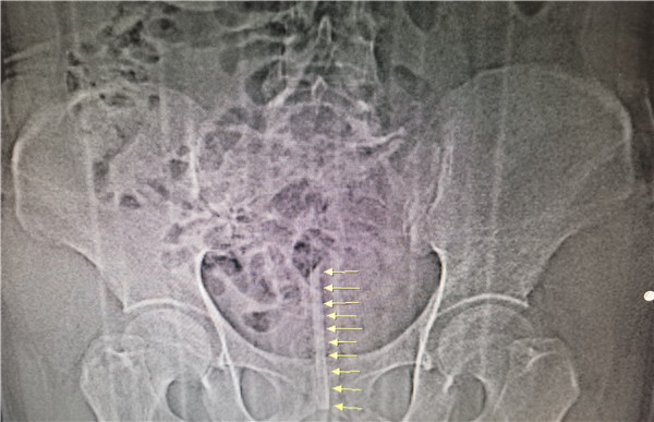 温度计解决尿路不通,温度计断裂卡尿道