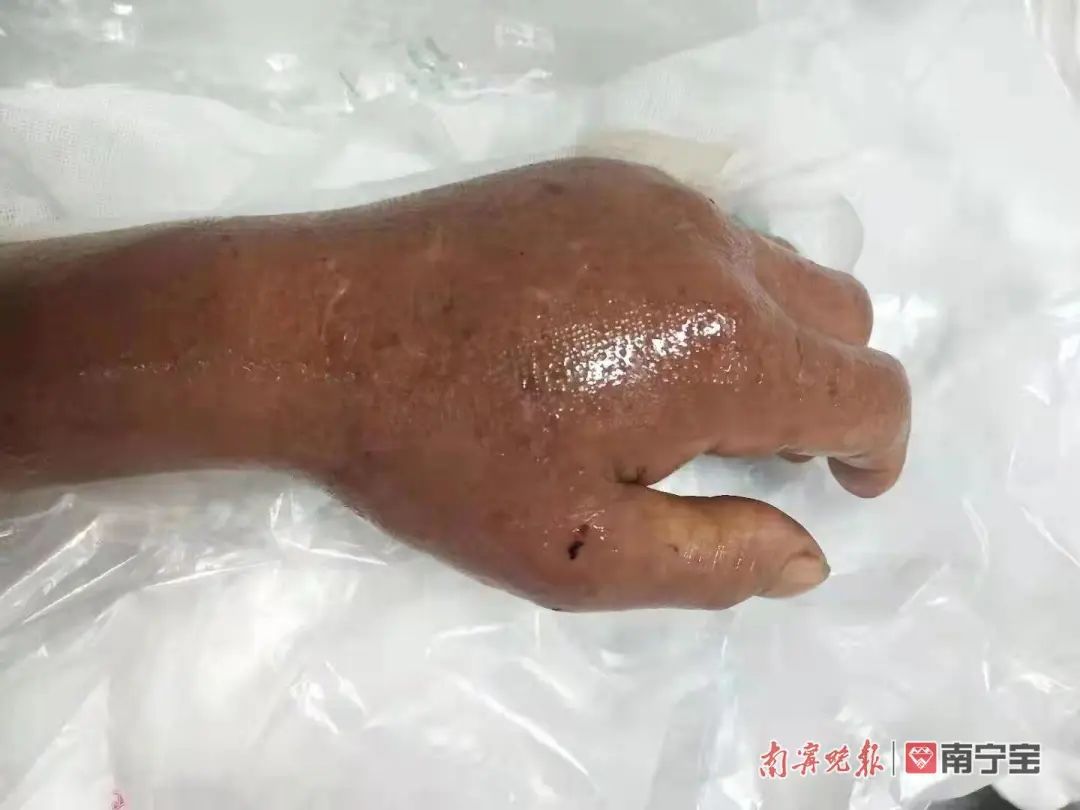 群众不小心被蛇咬伤,在山上被蛇咬伤后紧急处理办法