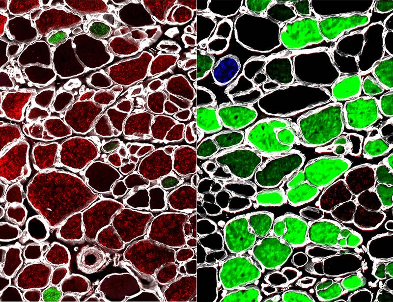 肌肉萎缩症靶向药,治疗癌症的药研究出来了吗